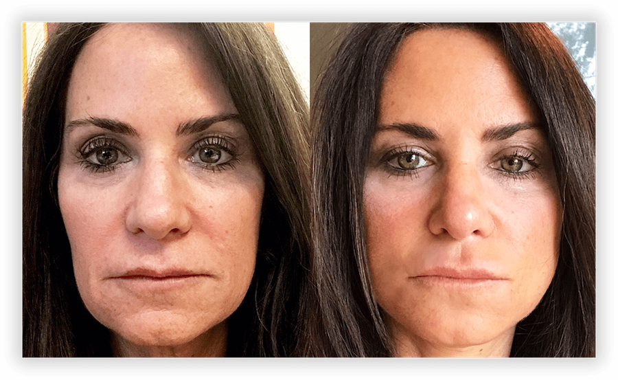 Non Surgical Facelift 2